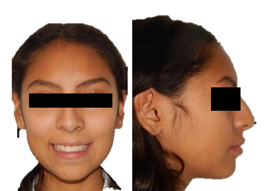 Fig.7 Extraoral frente sonrisa final perfil