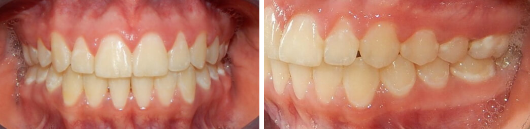 Fig. 8 Intraoral frente, lateral izquierda final