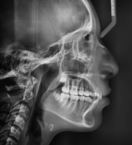 Fig.9 Radiografía lateral de cráneo final