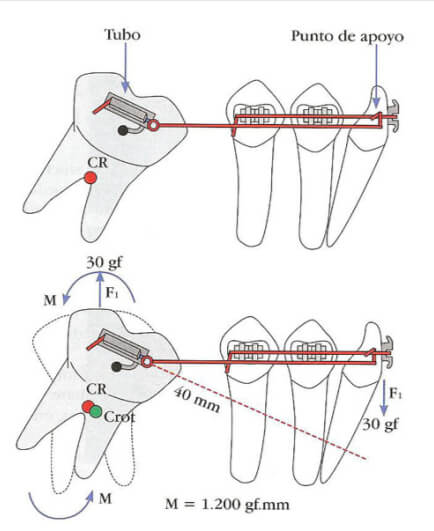 Figura 5. Imágenes  de Cantiliver con  su  F  y  M , el alambre  dentro del  tubo y punto de  apoyo de  un SFED.
Fuente: tomado de Gonzalo Uribe Ortodoncia  Teoría  clínica.