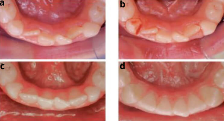 Figura 1. Tratamiento: Tallado de los dientes caducos, Corrección espontánea del apiñamiento de los incisivos inferiores después del tallado de la porción mesial de la corona de los caninos caducos inferiores. a. Antes del tallado. b . Justo después del tallado de los caninos caducos. c . Corrección espontánea del apiñamiento y de la rotación de los incisivos laterales, al cabo de seis meses. d .Resultado en la dentadura permanente. Tomado de Rosa MBOW ROSA M, Chirurgo Especialista en Ortognatodoncia M. Rev. Esp. Ortod. 33: 203- 14, 2003