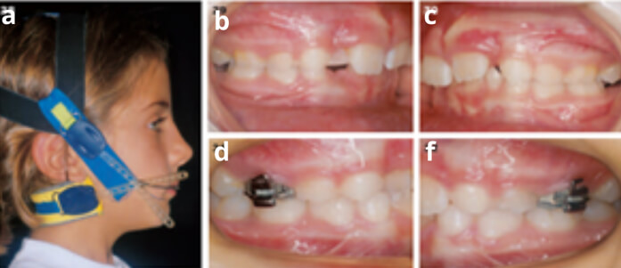 Figura 3. Tratamiento: expansión sagital de la arcada superior. Correccion de las relaciones de clase II molar y canina (caducos), de la a-f Tomado de Rosa MBOW ROSA M, Chirurgo Especialista en Ortognatodoncia M. Rev. Esp. Ortod. 33: 203- 14, 2003 