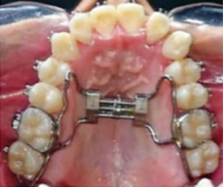 Figura 4. Tratamiento: expansor tipo Hyrax. Expansor maxilar tipo Hyrax.Tomado de Stefanny Espinosa Holguín, Beatriz Gurrola Martínez, Adán Casasa Araujo, Rev. Odontologia Vital, 2017, 29: 49-58