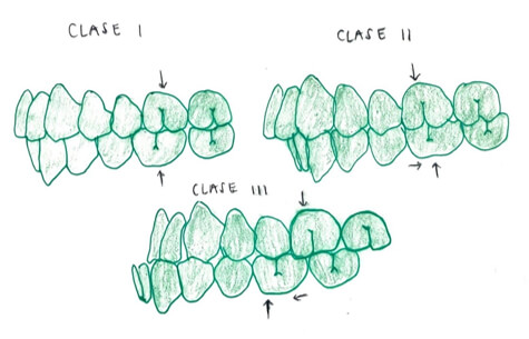 Esquema de las maloclusiones clases I, II y III según la clasificación de Angle. Fuente: propio autor