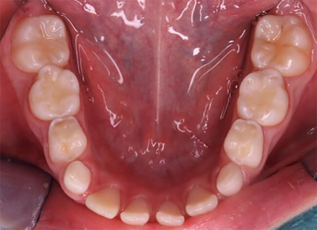 Figura 7 después de cuatro meses de seguimiento: Vista oclusal de arcada inferior con colocación de sellantes en piezas 3.6 y 4.6, y fluoración. 