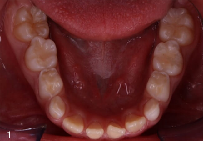 Figura 1: Arcada inferior en vista oclusal, desgarre en caras oclusales e incisales.