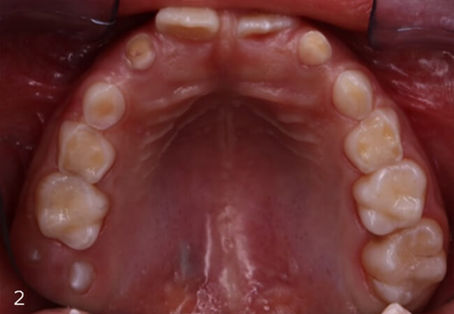 Figura 2: Arcada superior en vista oclusal, desgarre en caras oclusales e incisales.