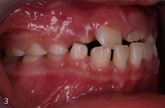 Figura 3: Vista lateral derecha, erosión en superficies incisales.