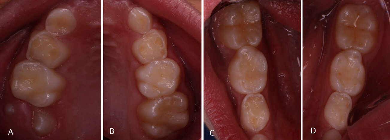 Figura 5: Vista oclusal del desgate dental por cuadrante. A cuadrante 1, B cuadrante 2, C cuadrante 4, D cuadrante 3.