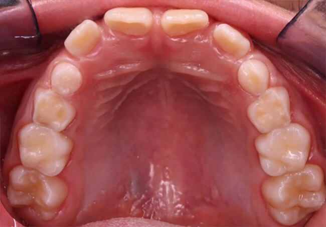 Figura 6 después de cuatro meses de seguimiento: Vista oclusal de arcada superior con colocación de sellantes en piezas 1.6 y 2.6, restauración de Ionómero de vidrio en pieza 5.3 y fluoración. 