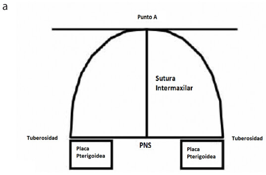 Figura modificada 1. Ilustraciones esquematicas  del desplazamiento maxilar