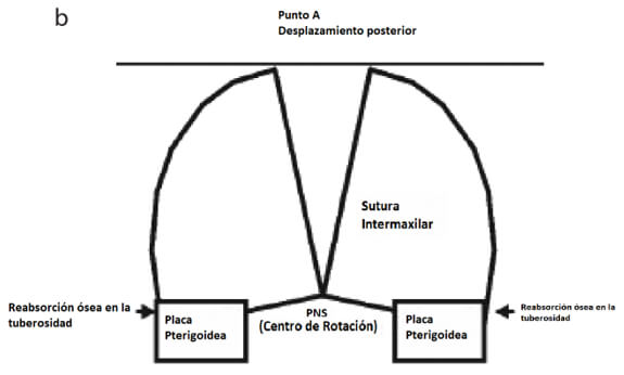 Figura modificada 1. Ilustraciones esquematicas  del desplazamiento maxilar