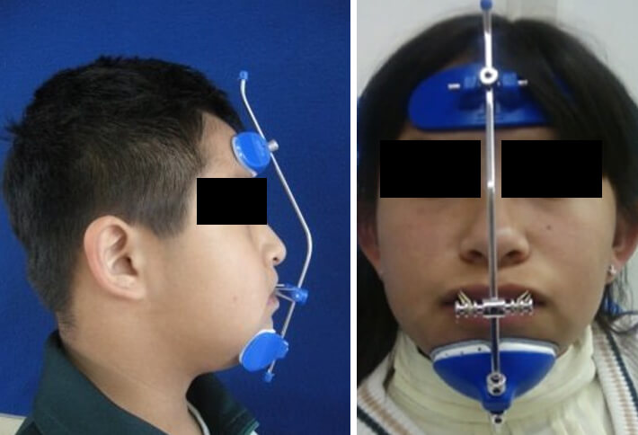 Figura 2. Componentes de la máscara facial, dos superficies de anclaje (Mentoniano y frontal) Conectadas por una varilla de acero, arco cruzado, y elásticos de cada lado. Fuente: https://www.ortodoncia.ws/publicaciones/2010/art-30/