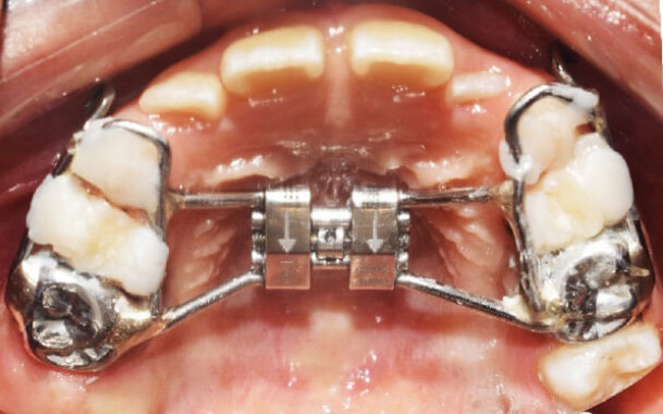 Figura 5. Expansión rápida maxilar con Aparato Hyrax previa a la instalación de mascara facial. Fuente: https://www.researchgate.net/figure/Figura-4-Expansion-maxilar-rapida-con-Aparato-Hyrax-previa-a-la-instalacion-de-mascara_fig3_335839184