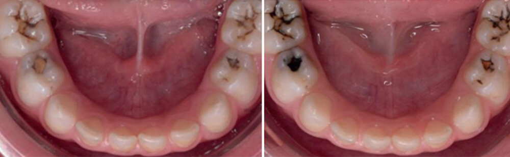 Imagen 1. Paciente de 2 años 9 meses. A: Fotografía inicial de la arcada inferior donde se observan las caries en las caras oclusales de los molares temporales. B: Dos semanas después de la aplicación del FDP se observa la tinción oscura de las zonas afectas.24