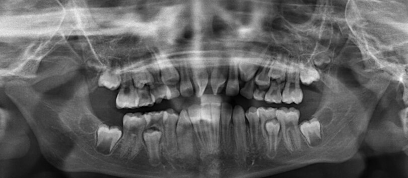 Imagen 4. Radiografía panorámica previa a tratamiento.