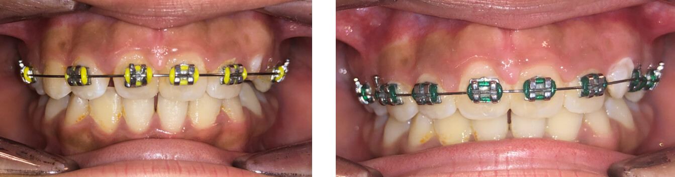 Imagen 7. Sexto y séptimo mes de tratamiento. Arco NiTi 0.16.