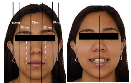 Fig. 1 Frente en reposo sonrisa