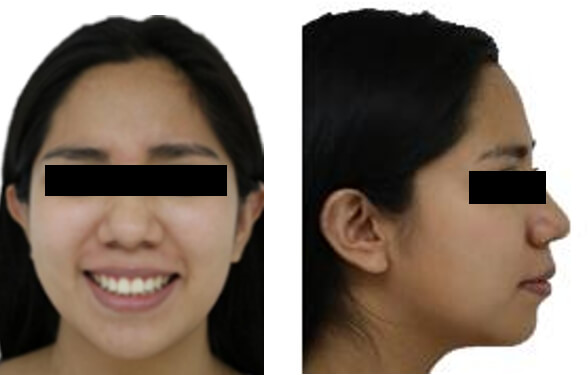 Fig. 10 Frente en sonrisa y perfil en reposo final