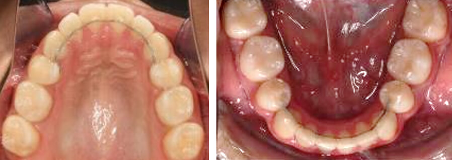 Fig. 14 Oclusal superior e inferior final