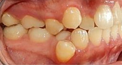 Fig. 4 Lateral derecha