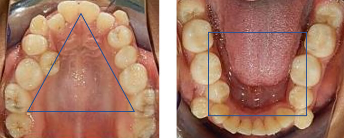 Fig. 6 Oclusal superior e inferior