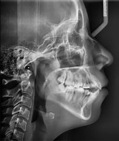 Fig.7 Radiografía lateral de cráneo