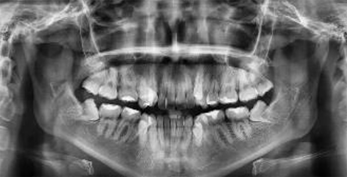 Fig. 8 Radiografía panorámica inicio