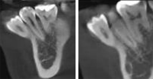 Fig. 9 CBCT de inicio vista sagital