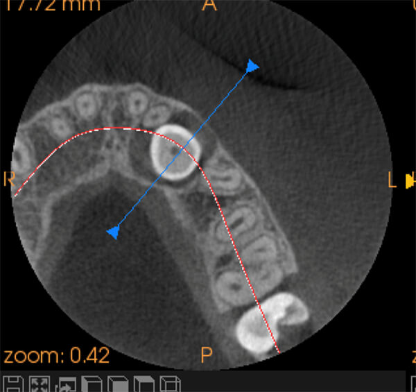 Fig 1: Plano Axial