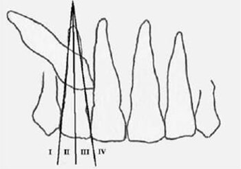 Fig. 2: Análisis de Ericson y Kurol (modificado por Lindahuer)