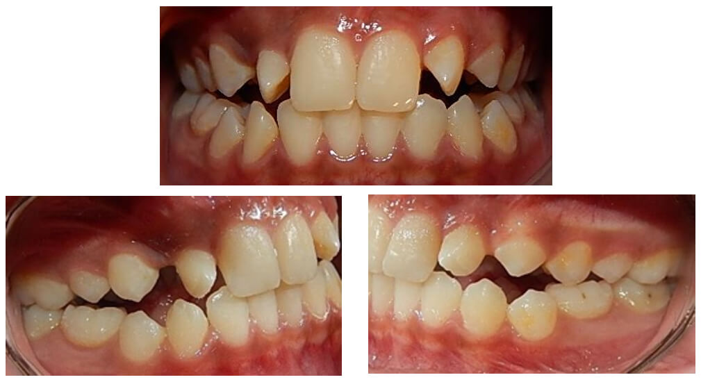 Fig. 2 Intraorales frente lateral derecha e izquierda