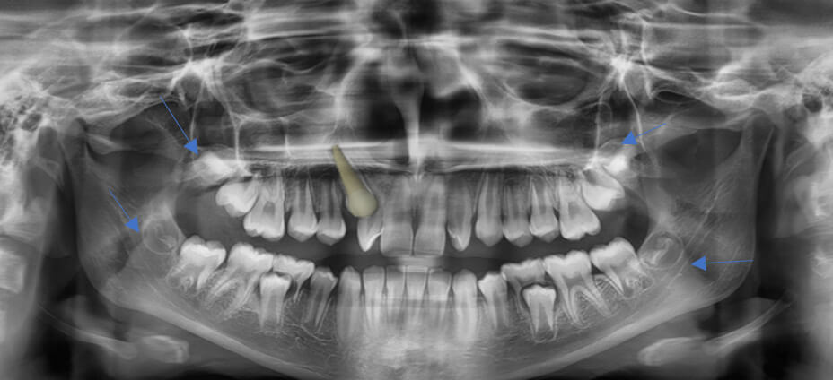 Fig. 3 Radiografía panorámica inicial.