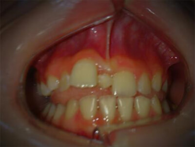 Fig. 2 Mordida abierta lateral