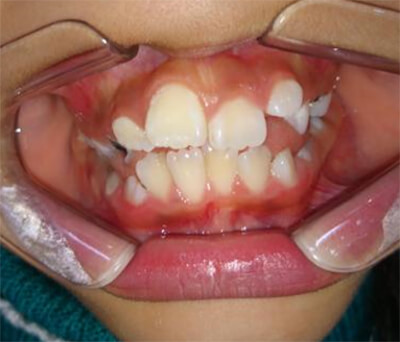 Fig. 3 Mordida abierta