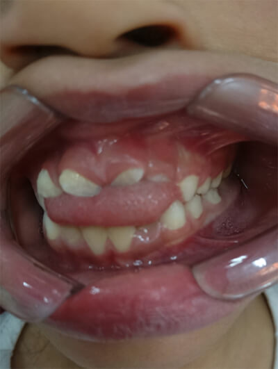 Fig.4 Mordida abierta anterior