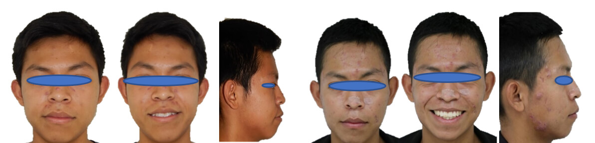 Fig. 10 Extraorales comparación de inicio frente, sonrisa y perfil finales.