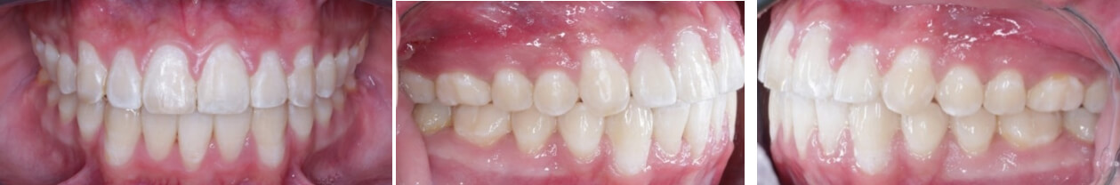 Fig. 11 Intraoral frente  derecha  izquierda final