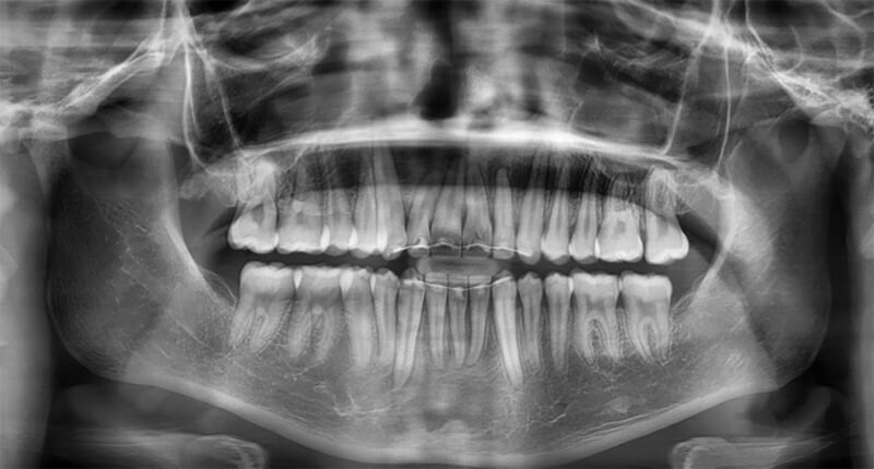 Fig. 13 Radiografía panorámica final