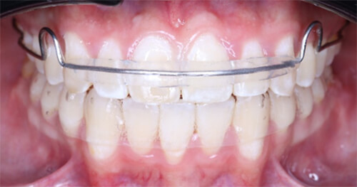 Fig. 14 Intraoral de frente con retenedores