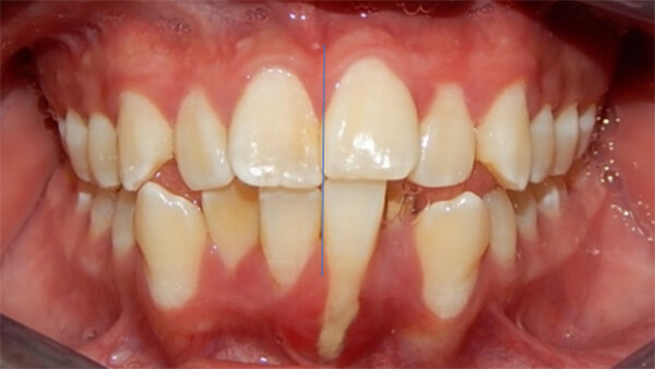 Fig. 4 Intraoral de frente