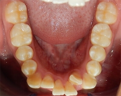 Fig. 5 Oclusal inferior forma de arco cuadrada