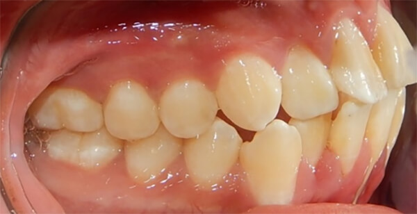 Fig. 6 Intraoral lateral derecha