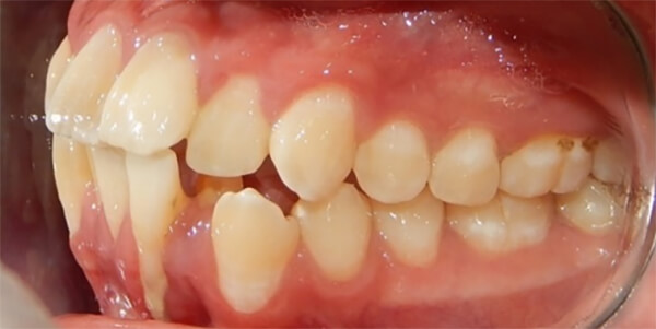 Fig. 7 Intraoral lateral izquierda