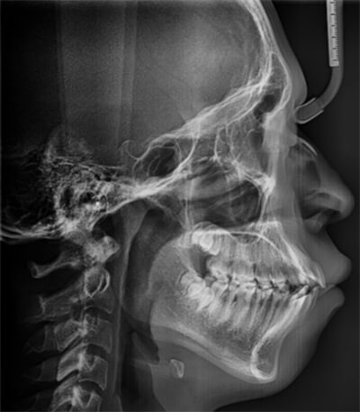 Fig. 8 radiografía lateral de cráneo