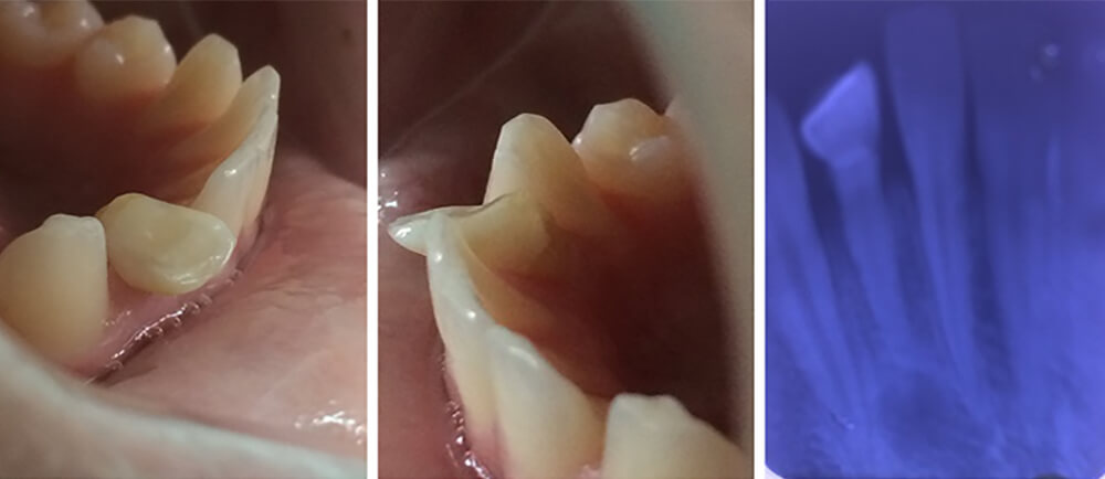 Figura 1: Fotografías iniciales laterales derecha e izquierda y radiografía inicial periapical.