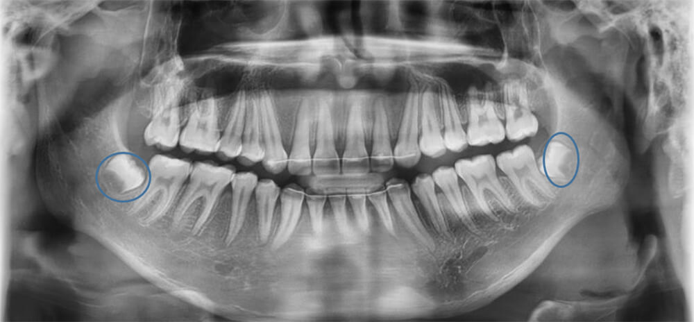 Fig.10 Radiografía panorámica final