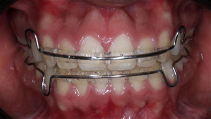 Fig.11 Intraoral de frente con retenedores