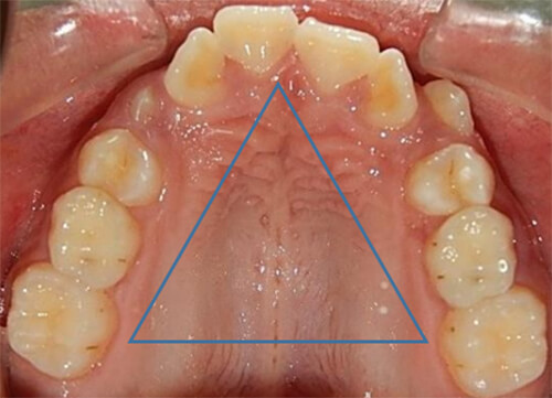 Fig.3 Oclusal superior forma de arco triangular