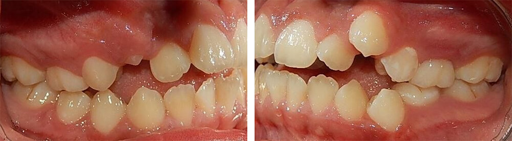 Fig.4 Intraoral lateral derecha e izquierda mordida abierta